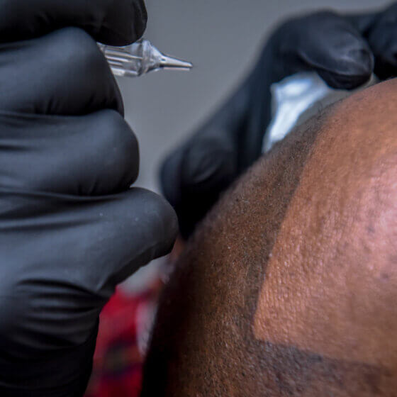 Scalp Micropigmentation In Dorset, Devon, Hampshire & Environs | SCALPPRO