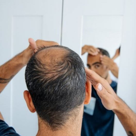 Scalp Micropigmentation In Dorset, Devon, Hampshire & Environs | SCALPPRO