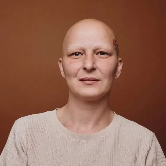 alopecia