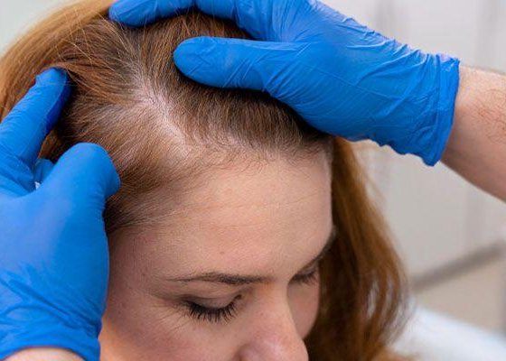 Female Hair Thinning Causes and Solutions