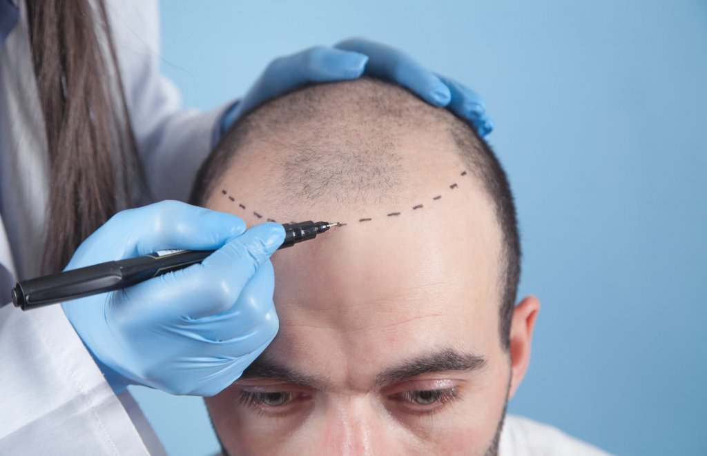 hair transplant vs scalp micropigmentation