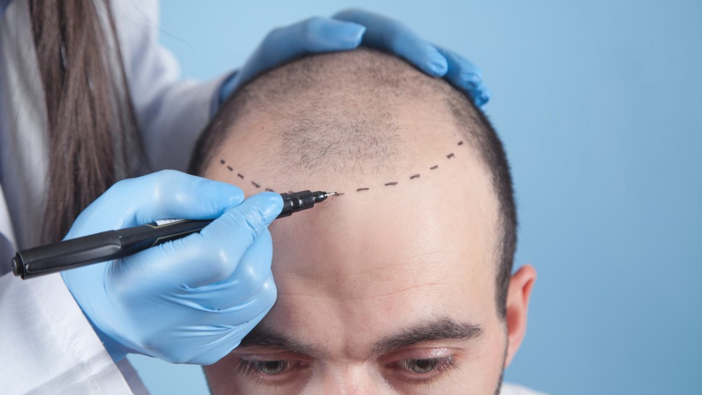 hair transplant vs scalp micropigmentation