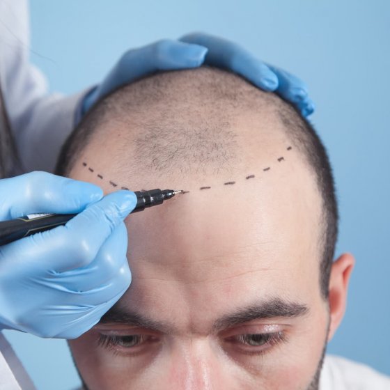 hair transplant vs scalp micropigmentation