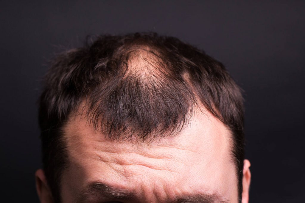 Male Head Close up With Baldness. Studio Black Background.