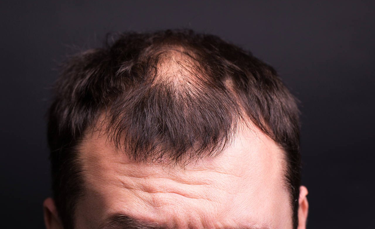 Male Head Close up With Baldness. Studio Black Background.