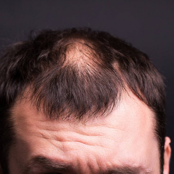 Male Head Close up With Baldness. Studio Black Background.