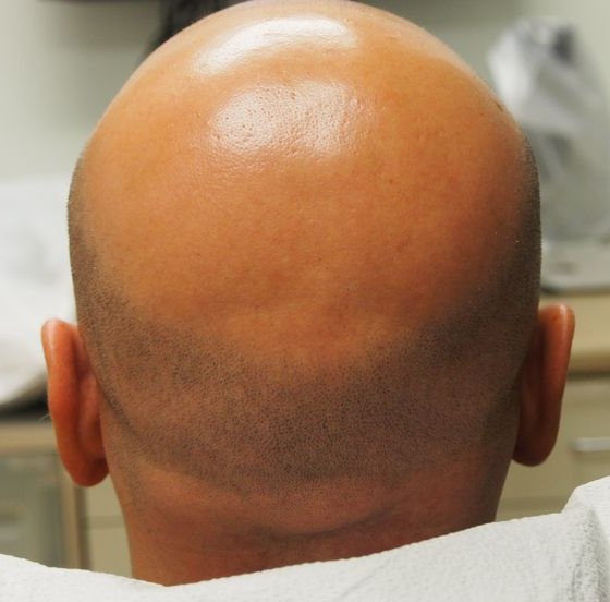 why hair loss in men