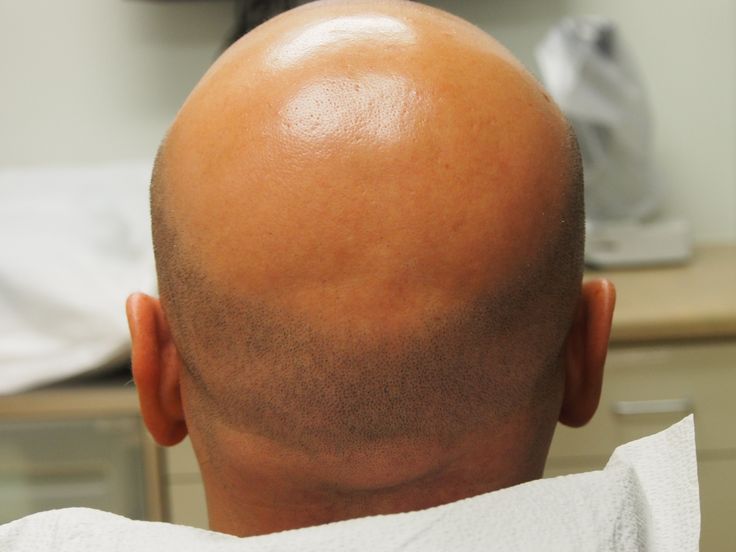 why hair loss in men